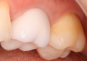 乙①-6　装着 拡大